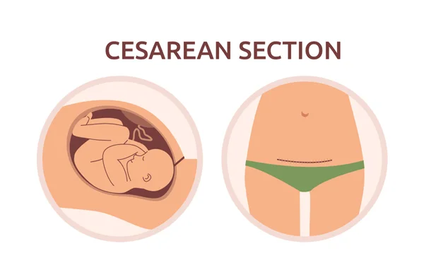 Caesarean Section