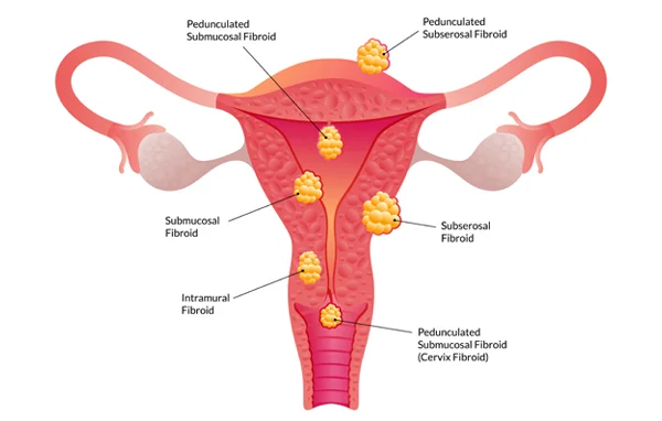 Fibroids